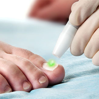 fungal laser treatment